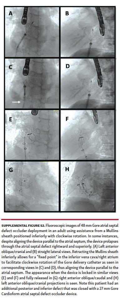 Mullins-Sheath Facilitated Delivery of Gore Cardioform ASD